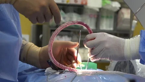 Back Surgery or Minimally Invasive Spine Surgery 8 Stock Footage 107048674