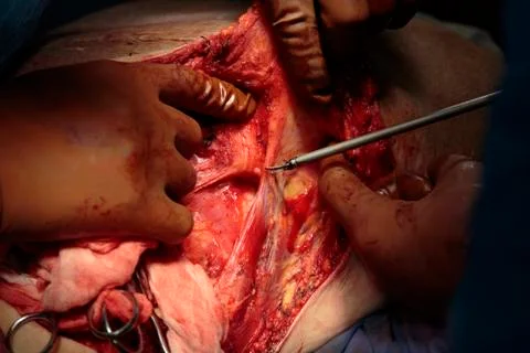 Back surgery 写真素材