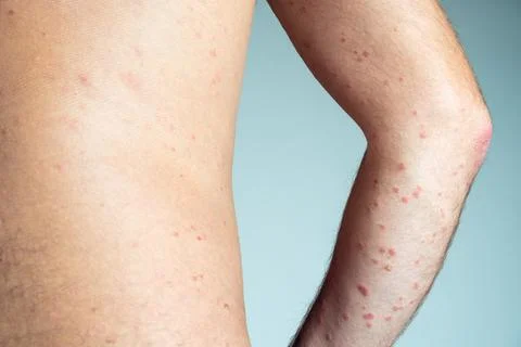Back view of bare elbow and back of unrecognizable man showing inflamed flaky Foto stock