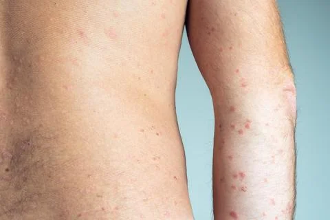 Back view of bare elbow and back of unrecognizable man showing inflamed scaly Foto stock