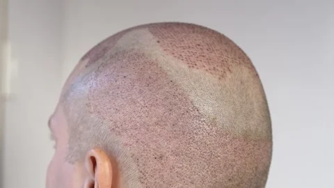 Back view of head after hair transplant showing donor and recipient areas during Stock Footage 327914741