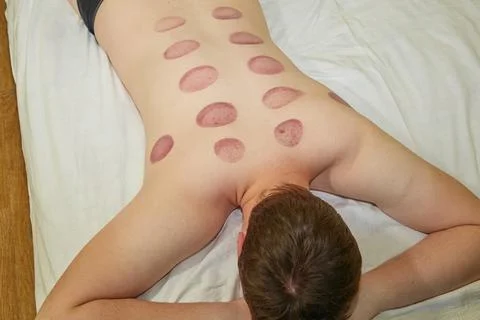 The back of a young man with the effects of vacuum massage, lying on a couch. Stock Photos