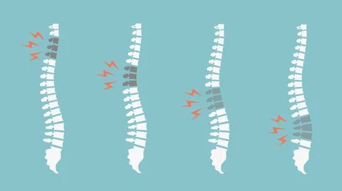 Backache spines set. Back pain vector icon illustration isolated. Damaged Disks Stock Illustration