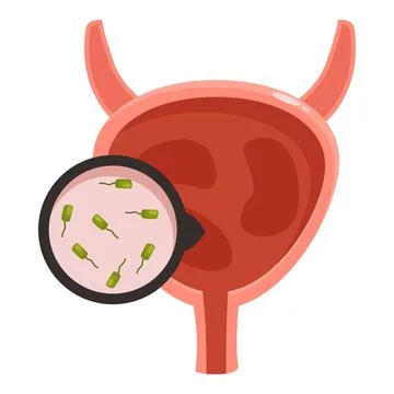 Bacteria infecting human bladder, showing cystitis or urinary tract infection Illustrazione stock