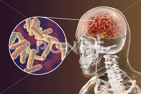 Bacterial brain infection medical concept, meningitis, encephalitis Stock Illustration