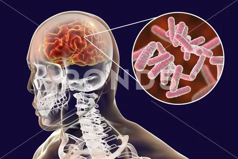 Bacterial brain infection medical concept, meningitis, encephalitis Stock Illustration