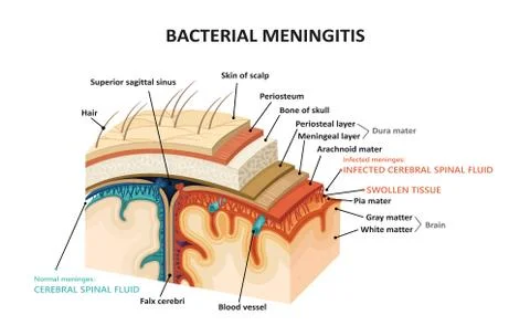 Bacterial meningitis Stock Illustration