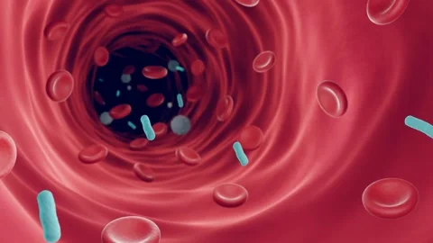 Bacterial Sepsis Stock Footage 188771691