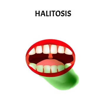 Bad breath. Halitosis. The structure of the teeth and oral cavity. Diseases of Stock Illustration