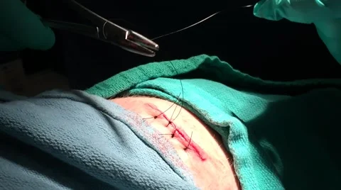 Bad cut getting stitched up Stock Footage 46482618