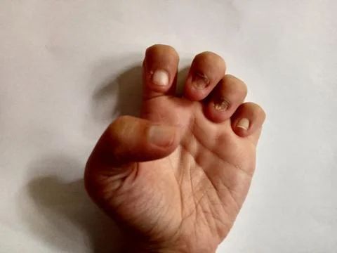 Bad Nails Stock Photos