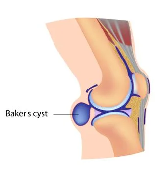 Baker's cyst Stock Illustration