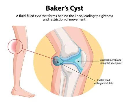 Baker's Cyst in the Knee Illustrazione stock