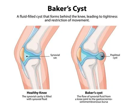 Baker's Cyst in the Knee Illustrazione stock