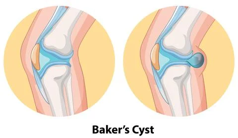 Baker's Cyst in Knee Joint Stock Illustration