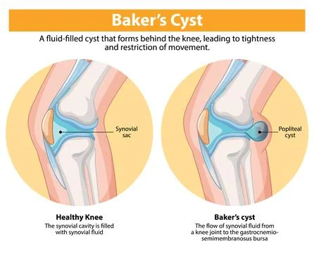 Baker's Cyst in Knee Joint Stock Illustration