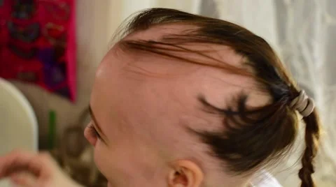 Bald Girl in hospital Stock Footage 59666111