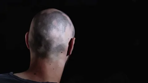 Bald head man rubbing his head, going through chemotherapy, close up shot Stock Footage 137609158
