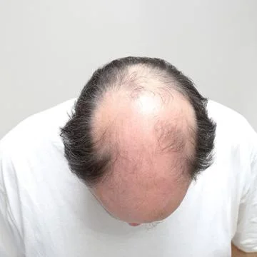 Bald Man Head Top Stock Photos