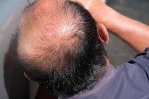 Bald man Stock Photos