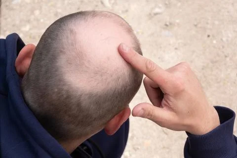 Bald man show problem gestures, concept alopecia in males. middle aged man su Stock Photos