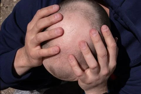 Bald men show problem gestures, concept alopecia in males Stock Photos