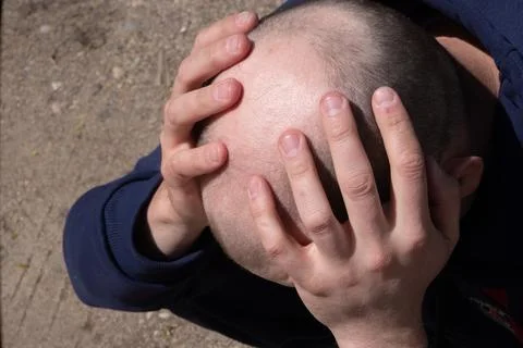 Bald men show problem gestures, concept alopecia in males Stock Photos
