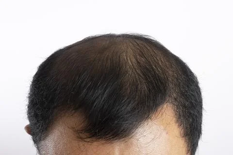 Bald in the middle head and begin no loss hair glabrous of mature Asian bus.. Stock Photos
