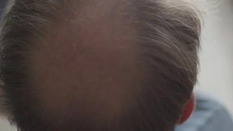 Bald spot on the back of man's head. Head slowly turning Stock Footage 150190168