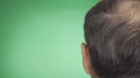 Bald spot on the top of the head Stock Footage 259945294
