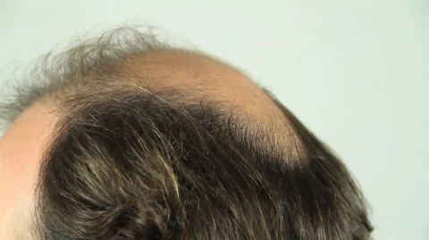Balding head 動画素材 8511667