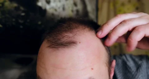 Balding man. The head of a man with sparse hair. Vidéo 148234661