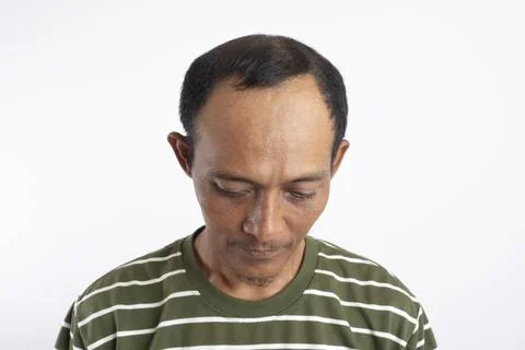 Baldness in the front and middle of the head and starting to not experience.. Stock Photos