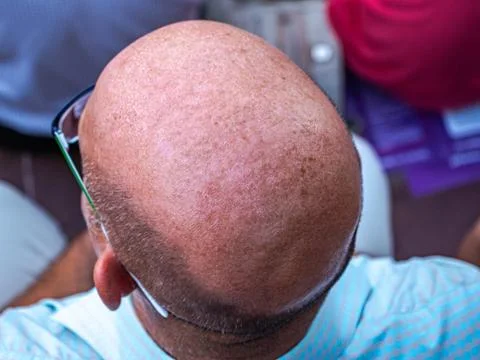 Baldness head from man close up Stock Photos