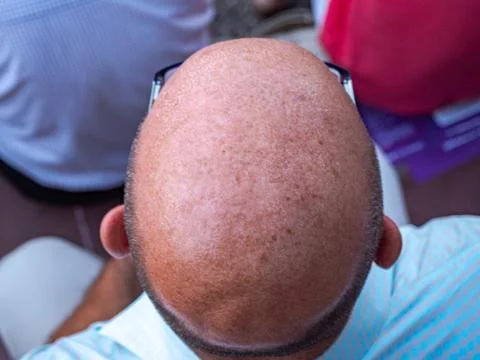 Baldness therapy from man head Stock Photos
