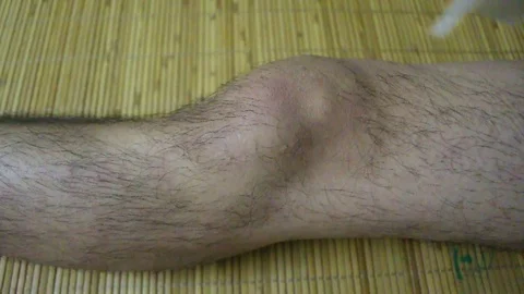 Bandages in the legs Stock Footage 78214643