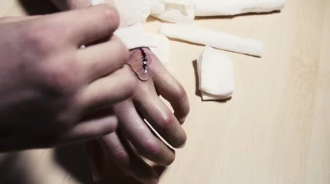 Bandaging broken arm Stock Footage 59977962