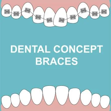 Banner Upper Braces teeth illustration vector on blue background. Dental conc Stock Illustration