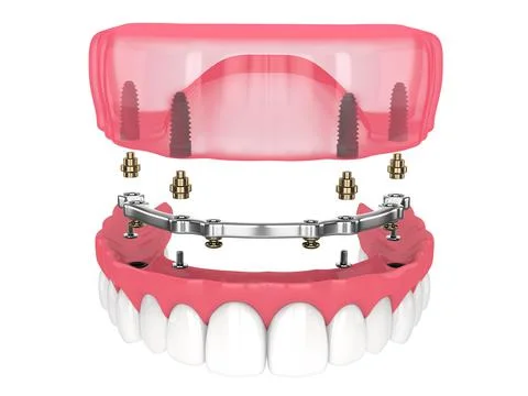 Bar retained removable overdenture installation supported by implants Illustrazione stock
