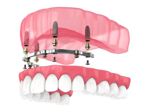 Bar retained removable overdenture installation supported by implants Stock Illustration