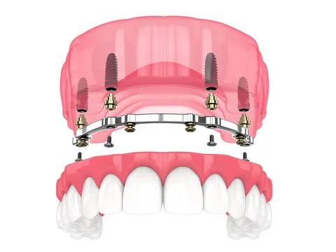 Bar retained removable overdenture installation supported by implants Stock Illustration