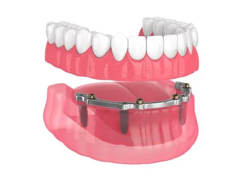 Bar retained removable overdenture installation supported by implants Stock Illustration