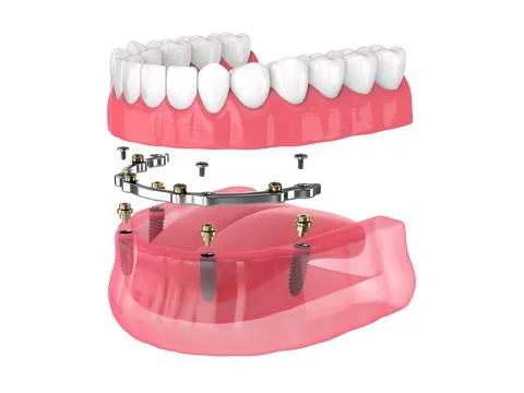 Bar retained removable overdenture installation supported by implants Stock Illustration