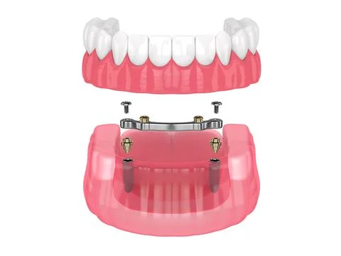 Bar retained removable overdenture installation supported by implants Stock Illustration