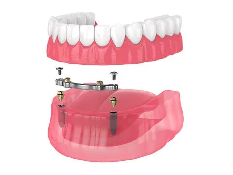 Bar retained removable overdenture installation supported by implants Stock Illustration