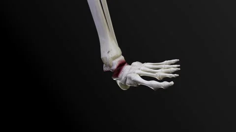 Bare bone fracture  HD Video stock 285108862