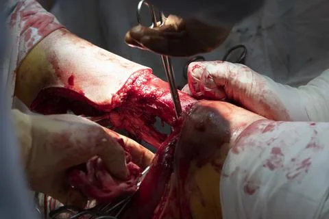 Bare Bone In Leg Amputation Surgery Stockfoto's