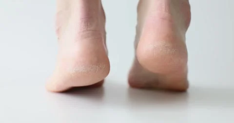 Bare feet with calluses and corns and dry skin closeup 4k movie slow motion Stock Footage 275156433