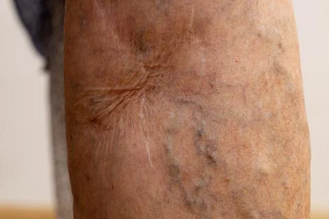 Bare leg with scar after surgeon operation for blood vessels, protruding Stock Photos