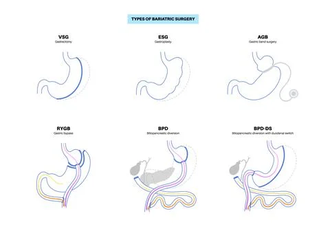 Bariatric surgery poster Illustrazione stock